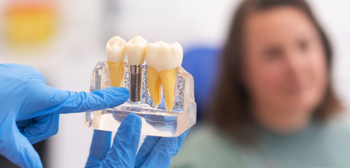 what are the 3 stages of dental implants