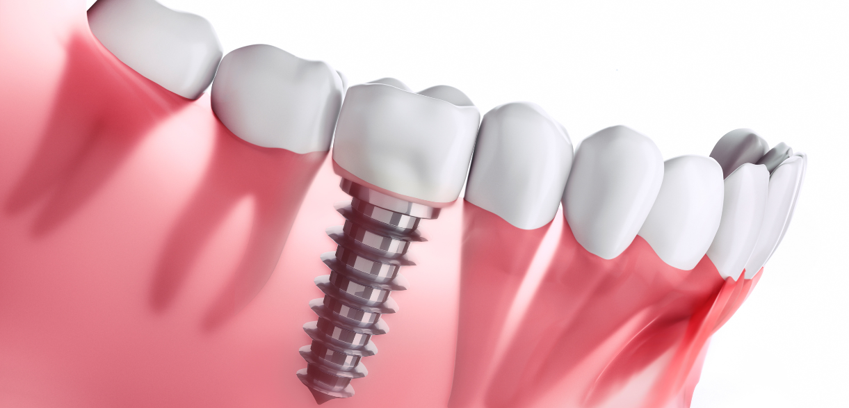 Can You Restore Your Missing Teeth?