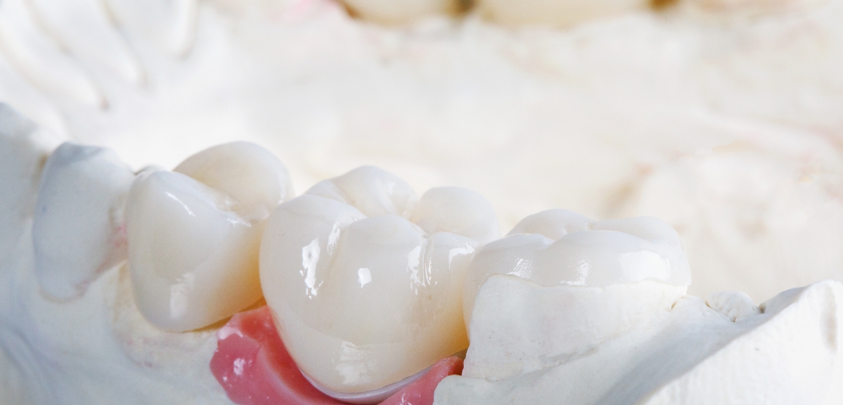 How Do I Make My Crowns Last Longer?