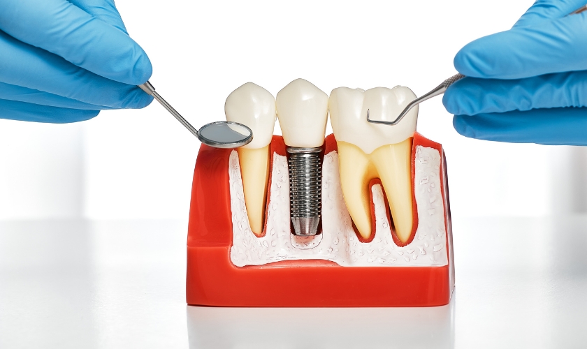 dental implants in Cambridge